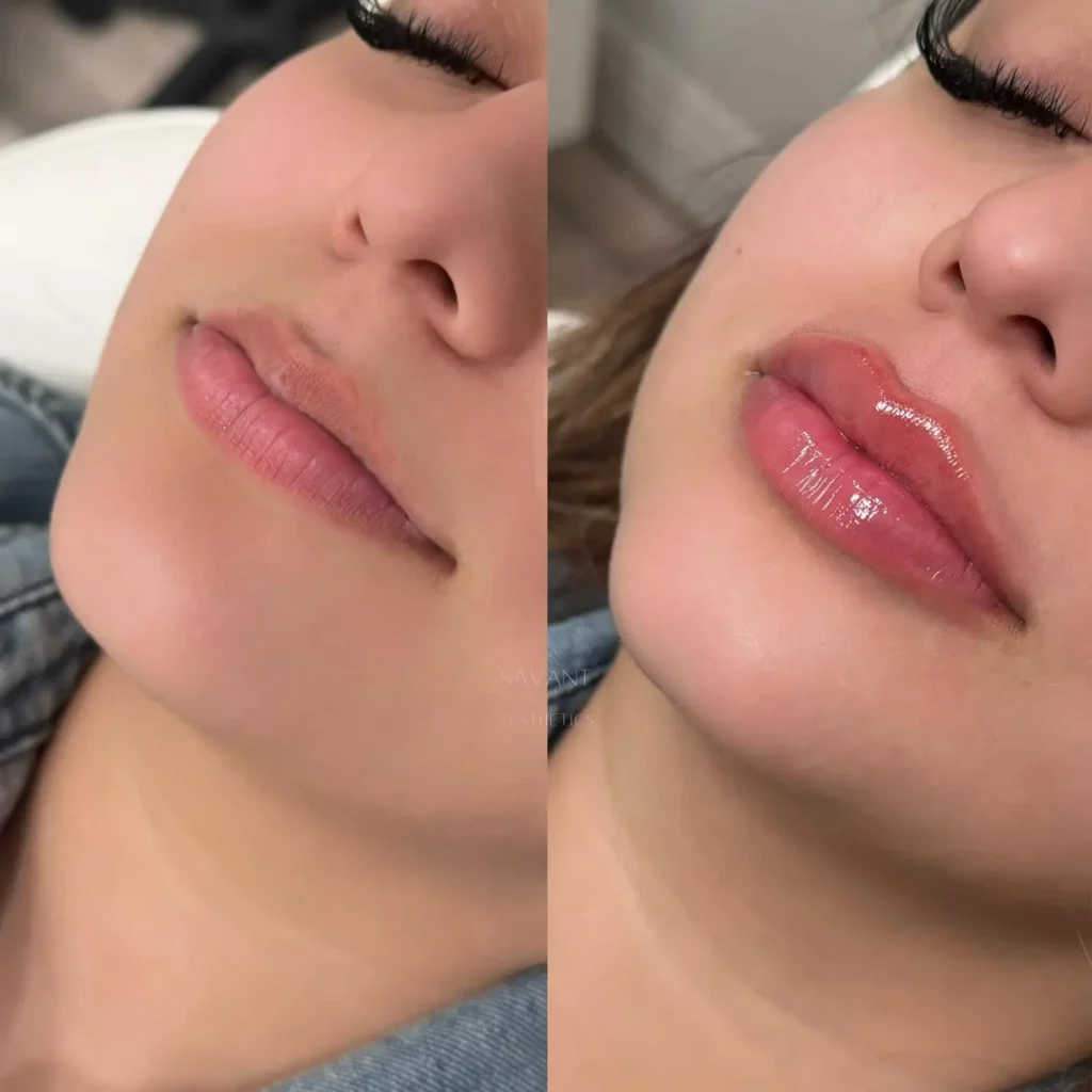 Lip Filler Before and After