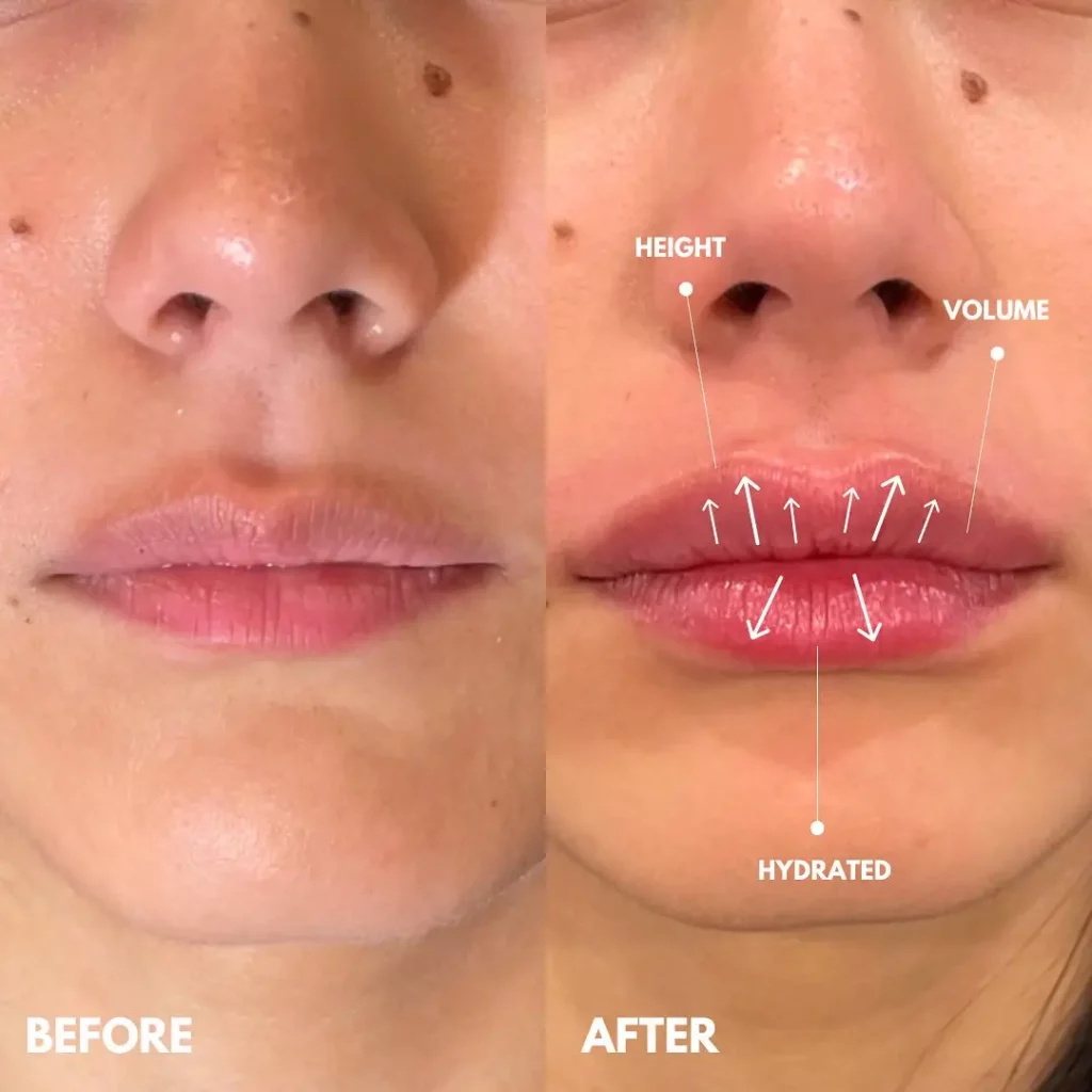 Lip Filler Before and After