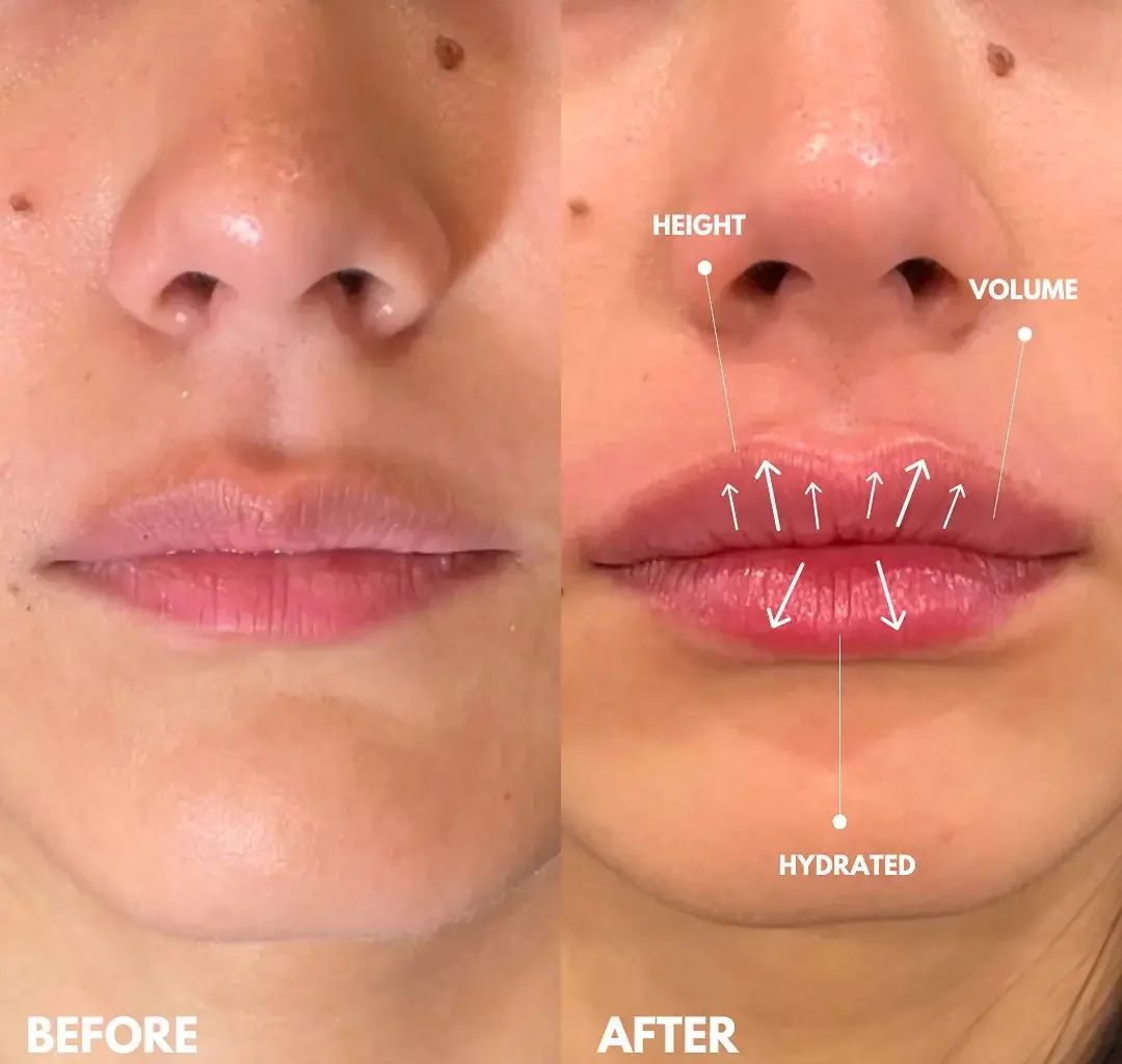 Lip Filler Before and After