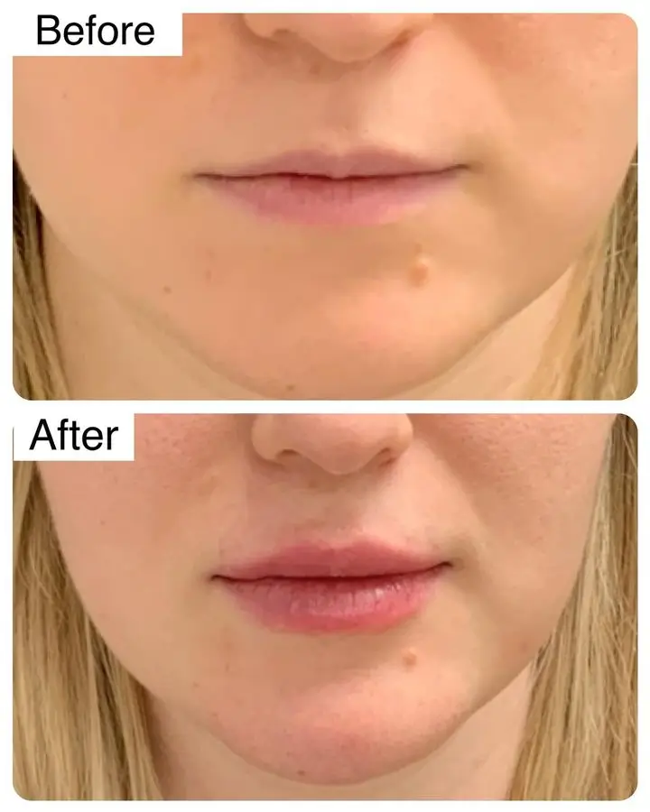 Lip Filler Before and After