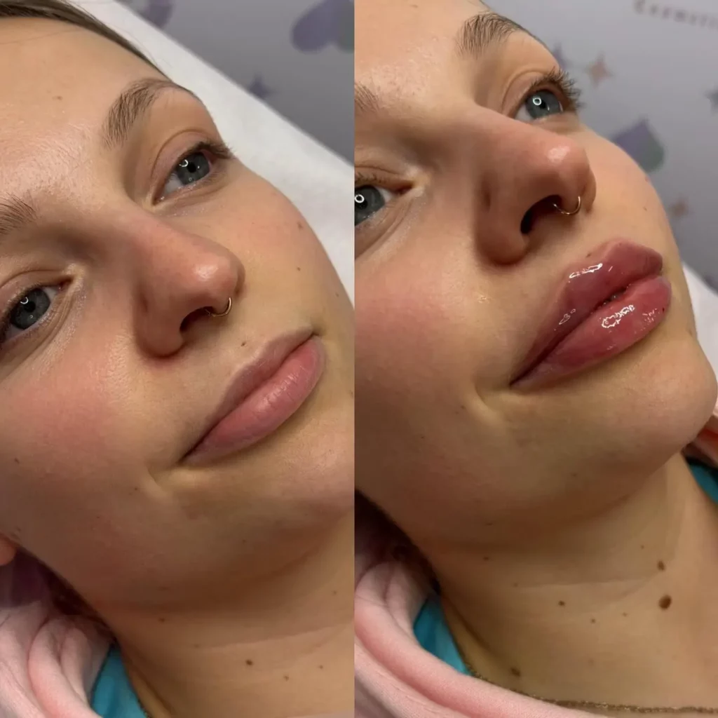 Lip Filler Before and After