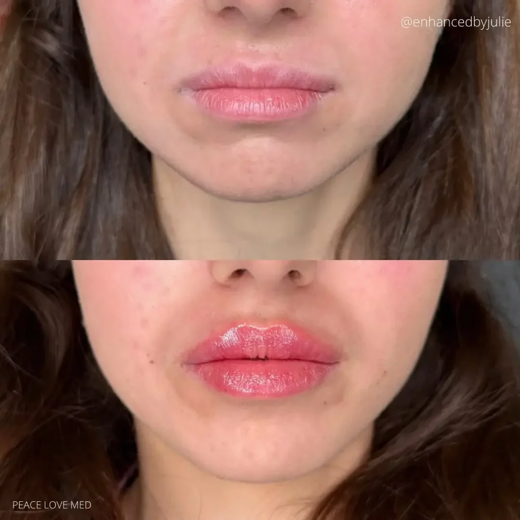 Lip Filler Before and After