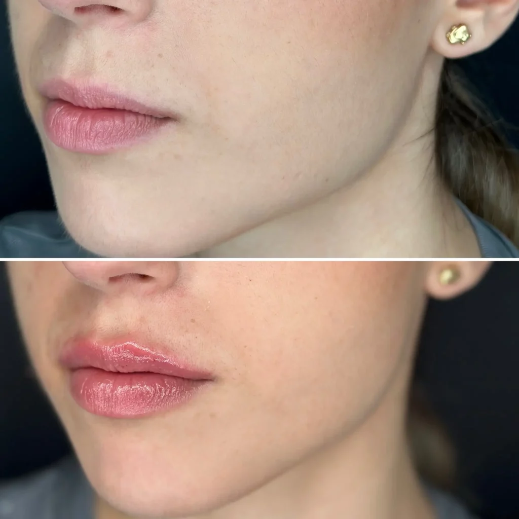 Lip Filler Before and After