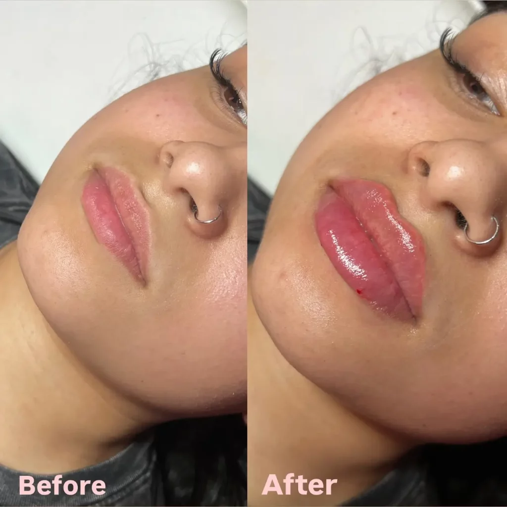 Lip Filler Before and After