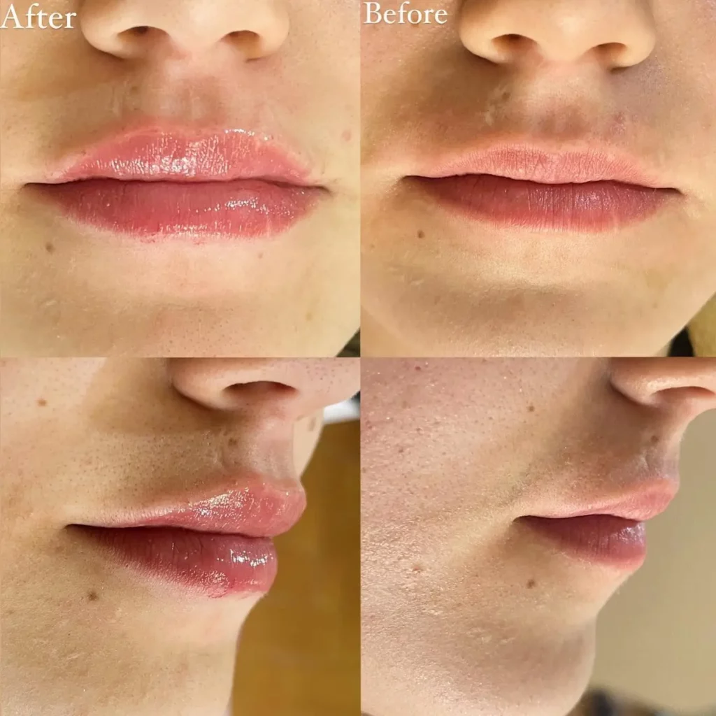 Lip Filler Before and After