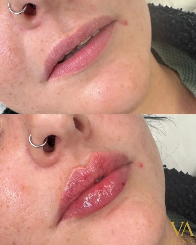 Lip Filler Before and After