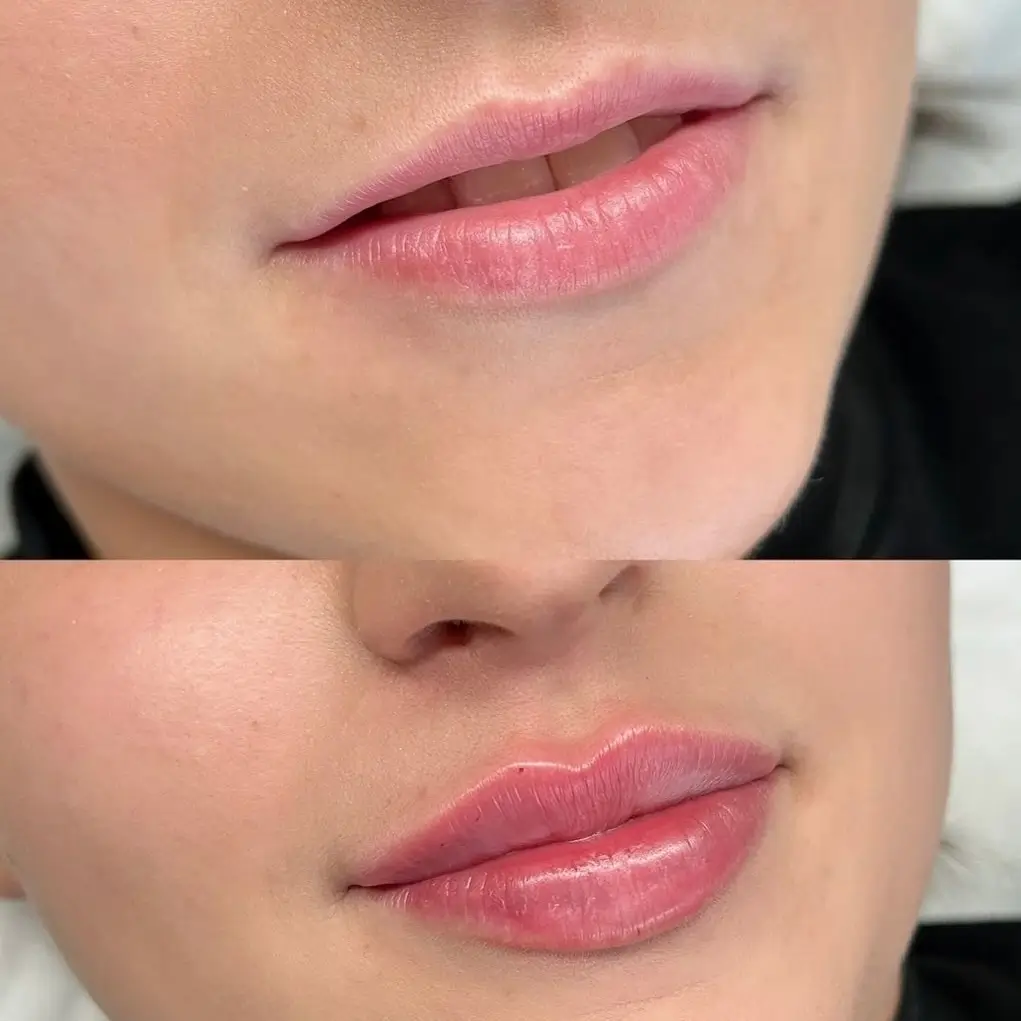 Lip Filler Before and After