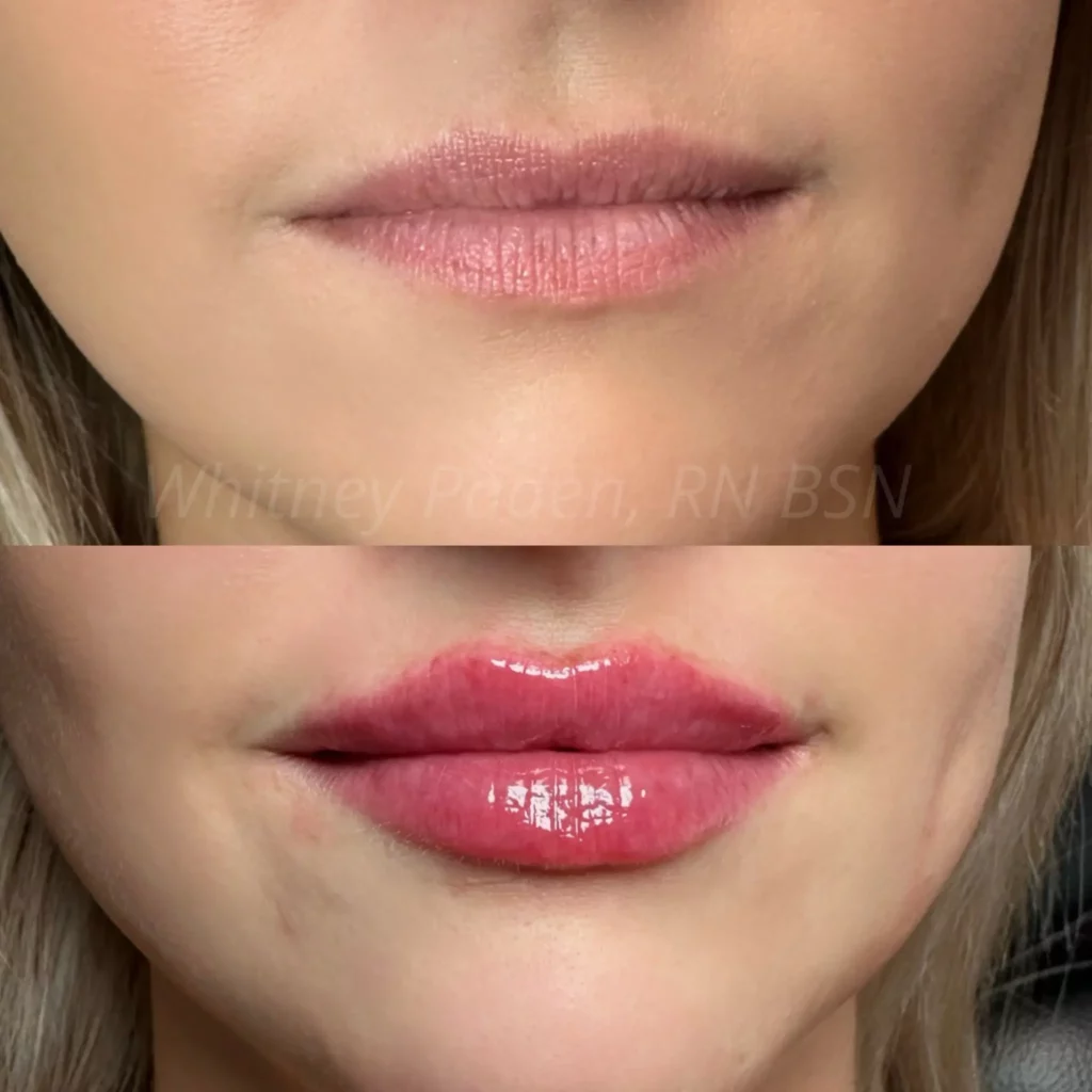 Lip Filler Before and After