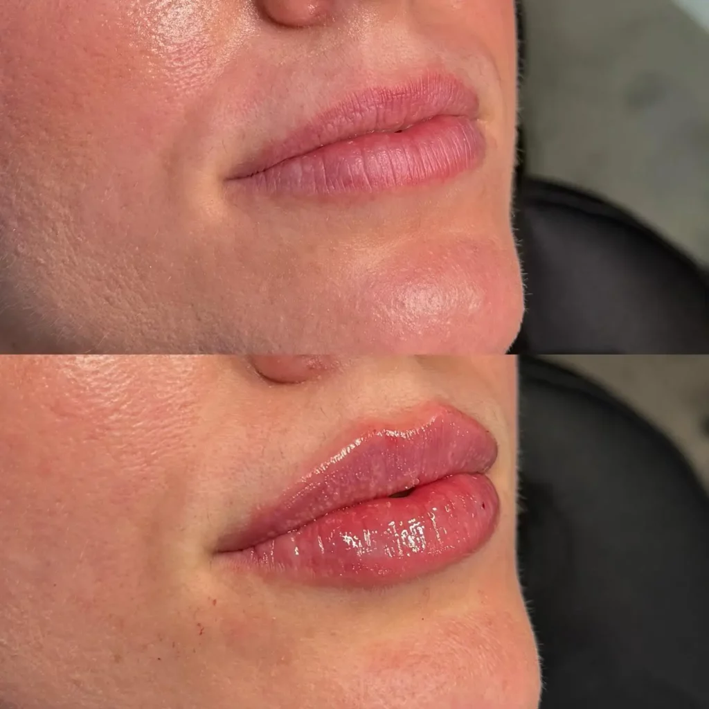 Lip Filler Before and After