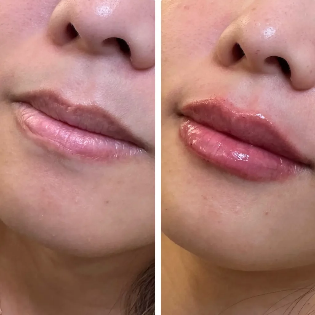 Lip Filler Before and After