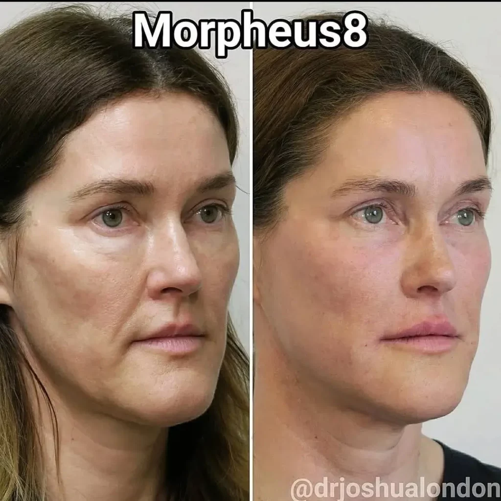 Morpheus8 Before and After