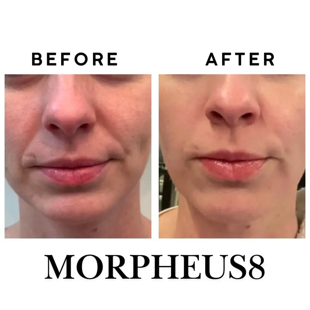 Morpheus8 Before and After