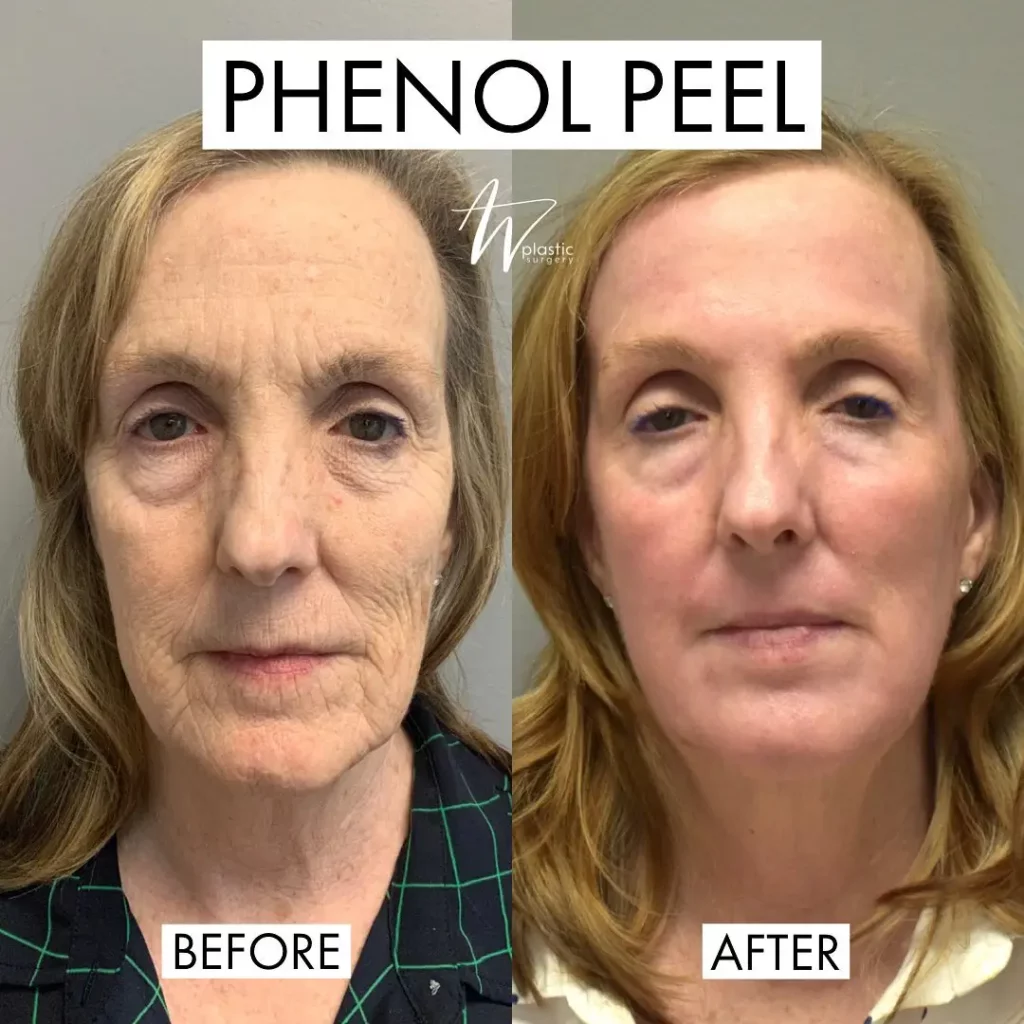 Phenol Peel Before and After