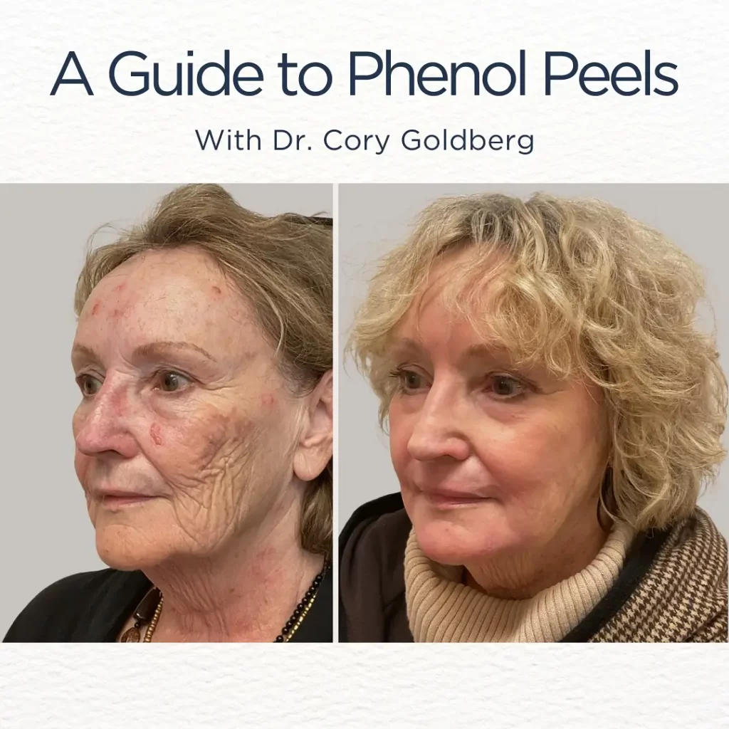 Phenol Peel Before and After