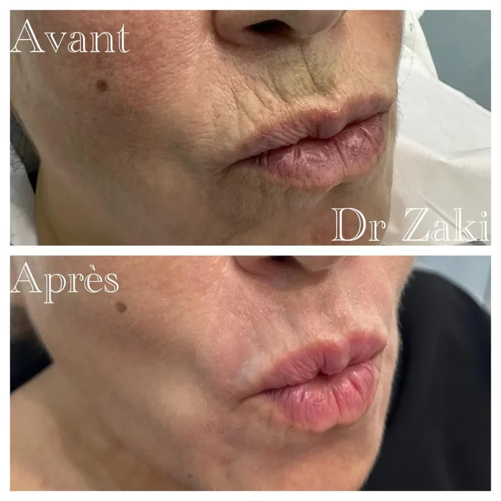 Phenol Peel Before and After