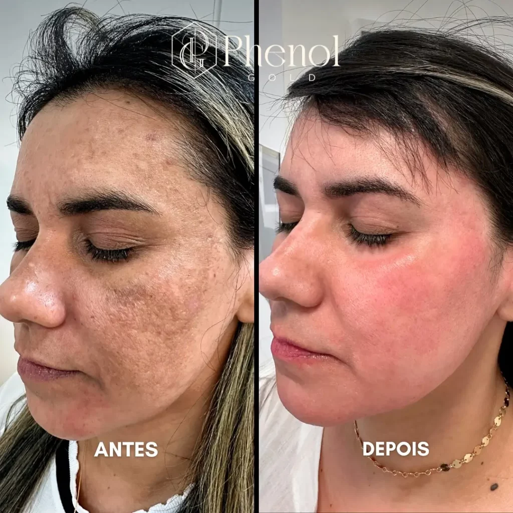 Phenol Peel Before and After