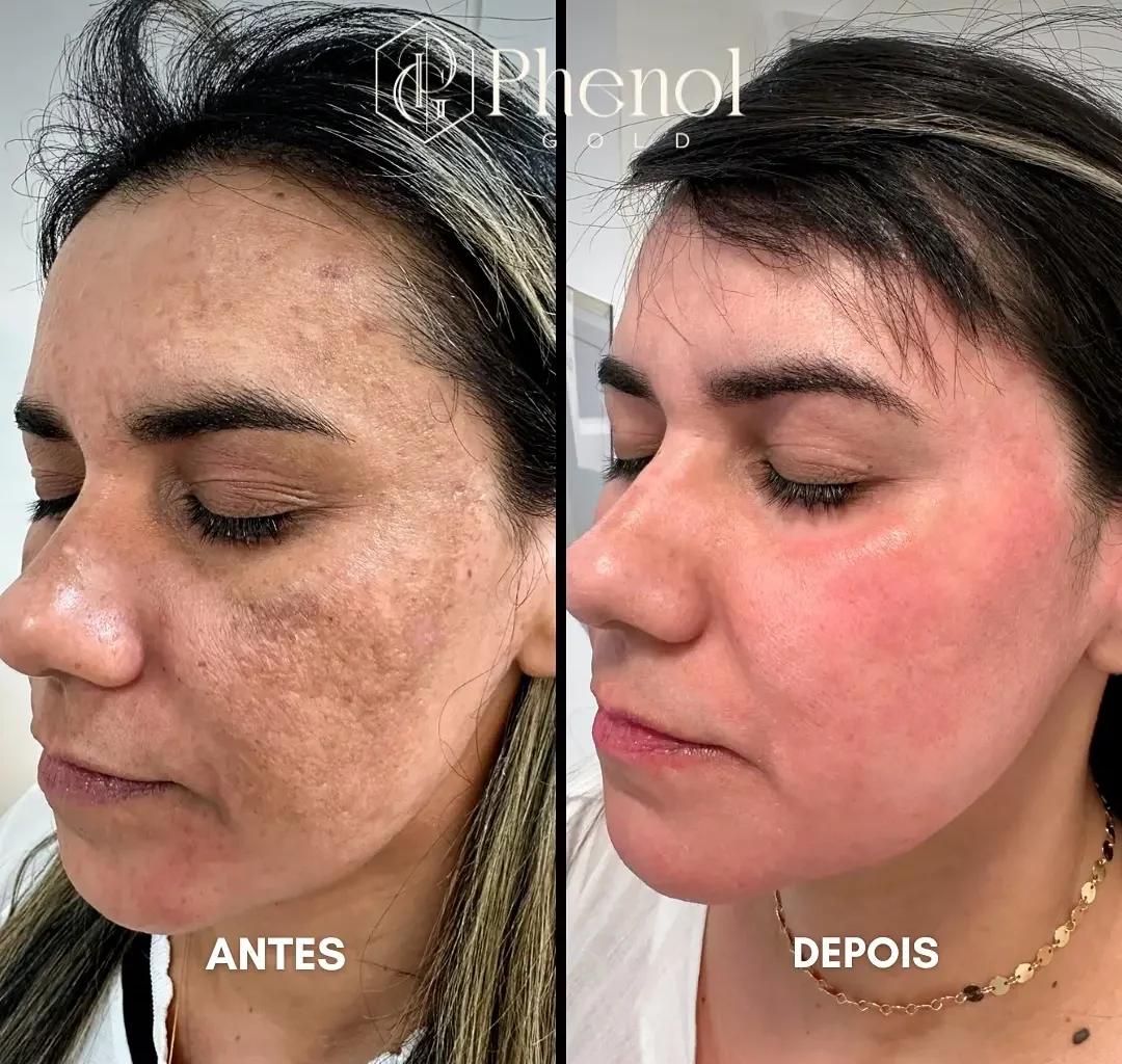 Phenol Peel Before and After