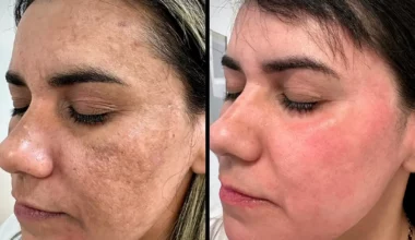 Phenol Peel Before and After