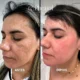 Phenol Peel Before and After