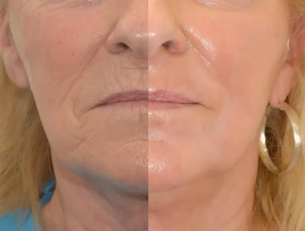 Phenol Peel Before and After