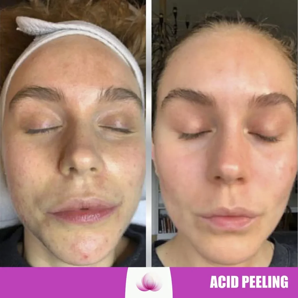 Phenol Peel Before and After