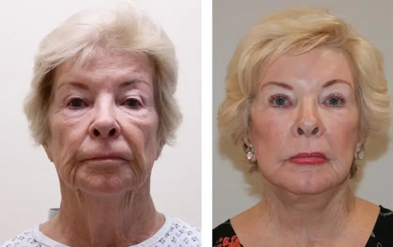 Phenol Peel Before and After