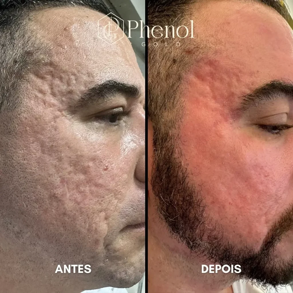 Phenol Peel Before and After