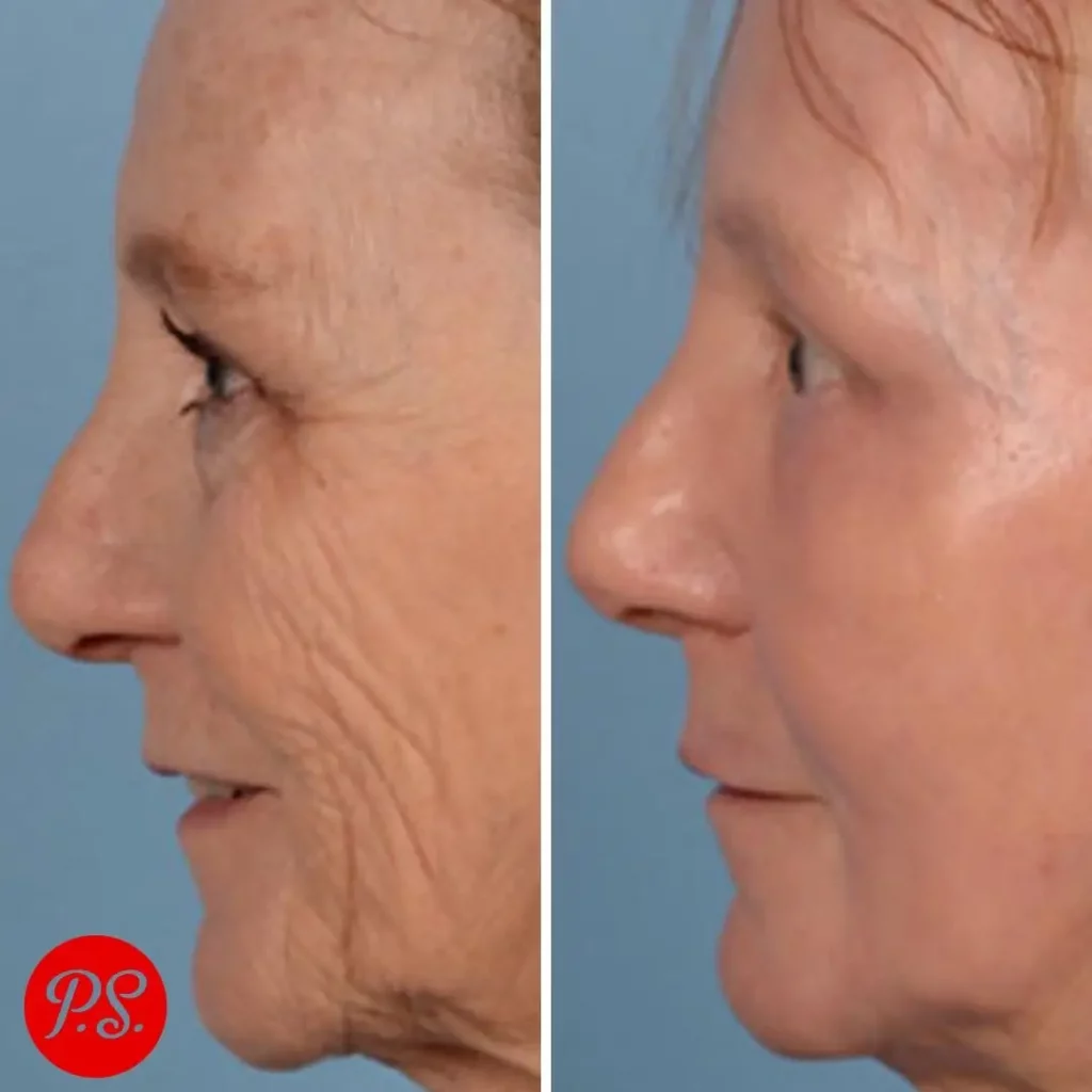 Phenol Peel Before and After