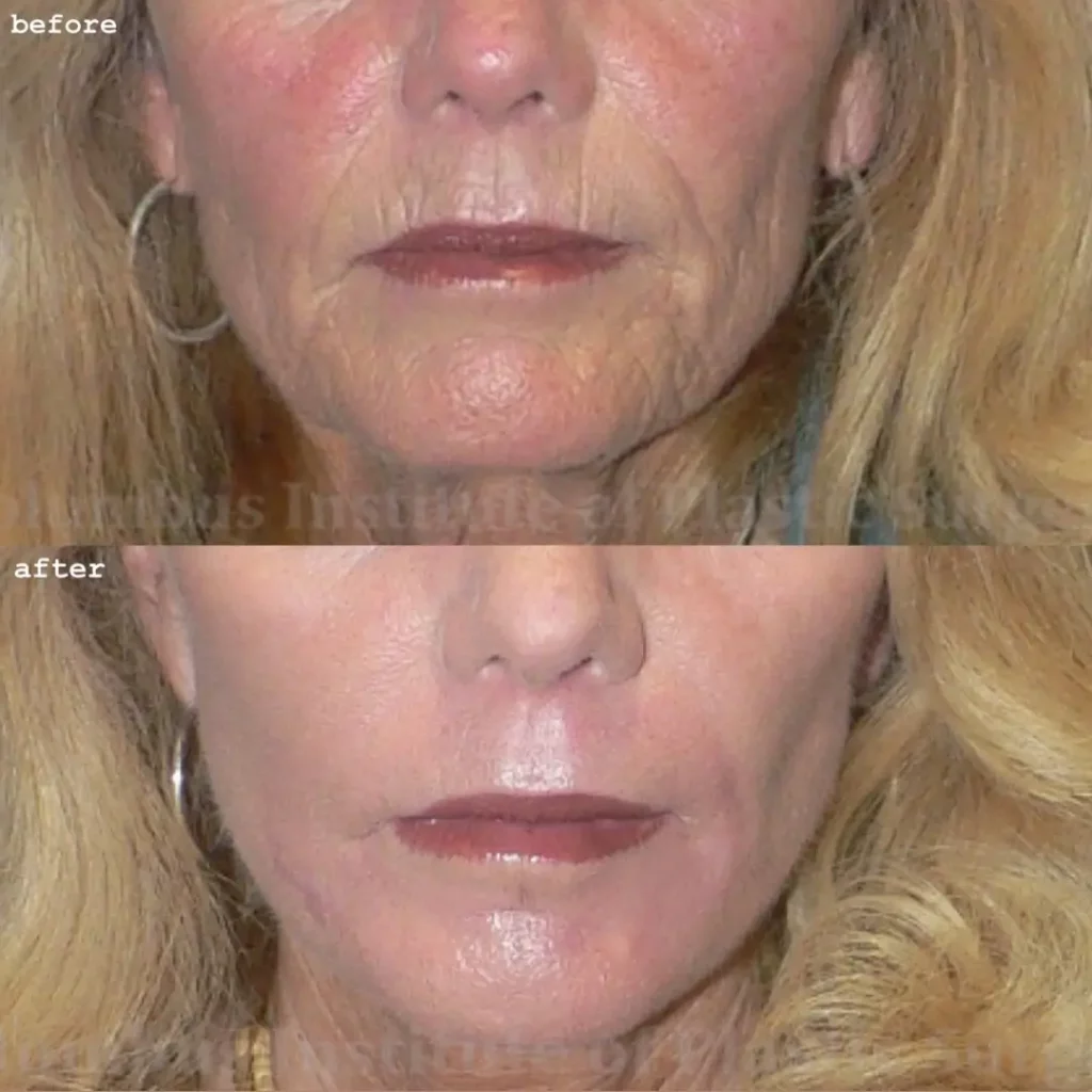 Phenol Peel Before and After