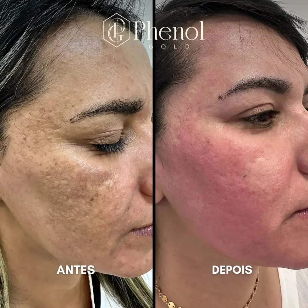 Phenol Peel Before and After