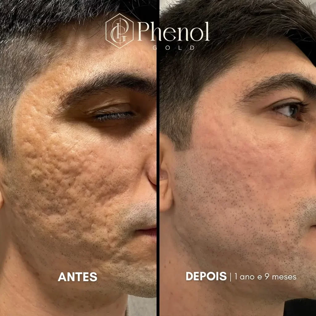 Phenol Peel Before and After