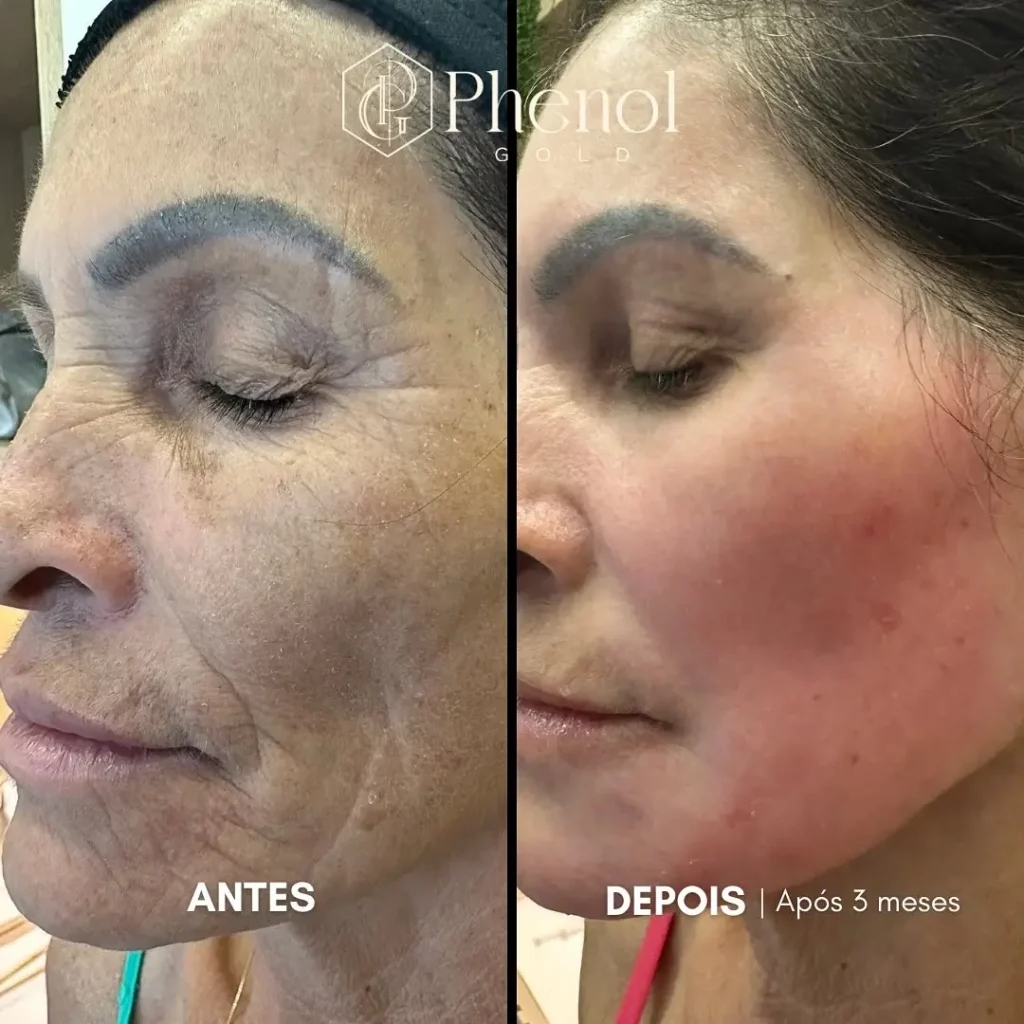 Phenol Peel Before and After