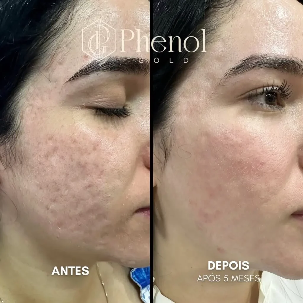 Phenol Peel Before and After