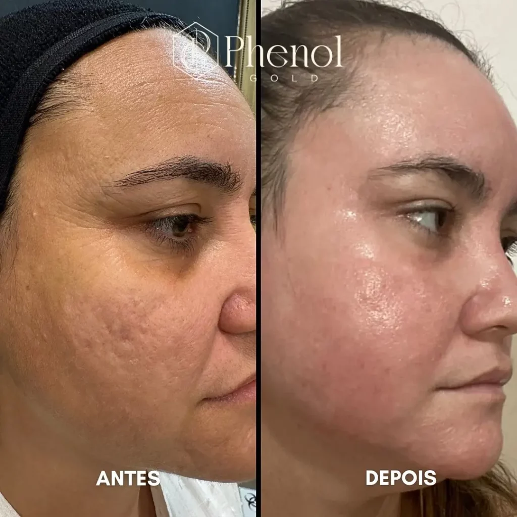 Phenol Peel Before and After