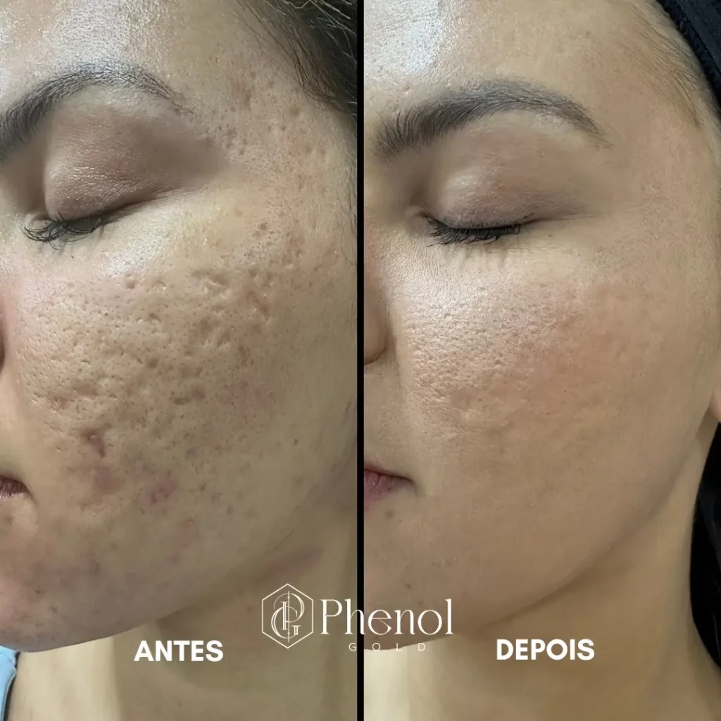 Phenol Peel Before and After