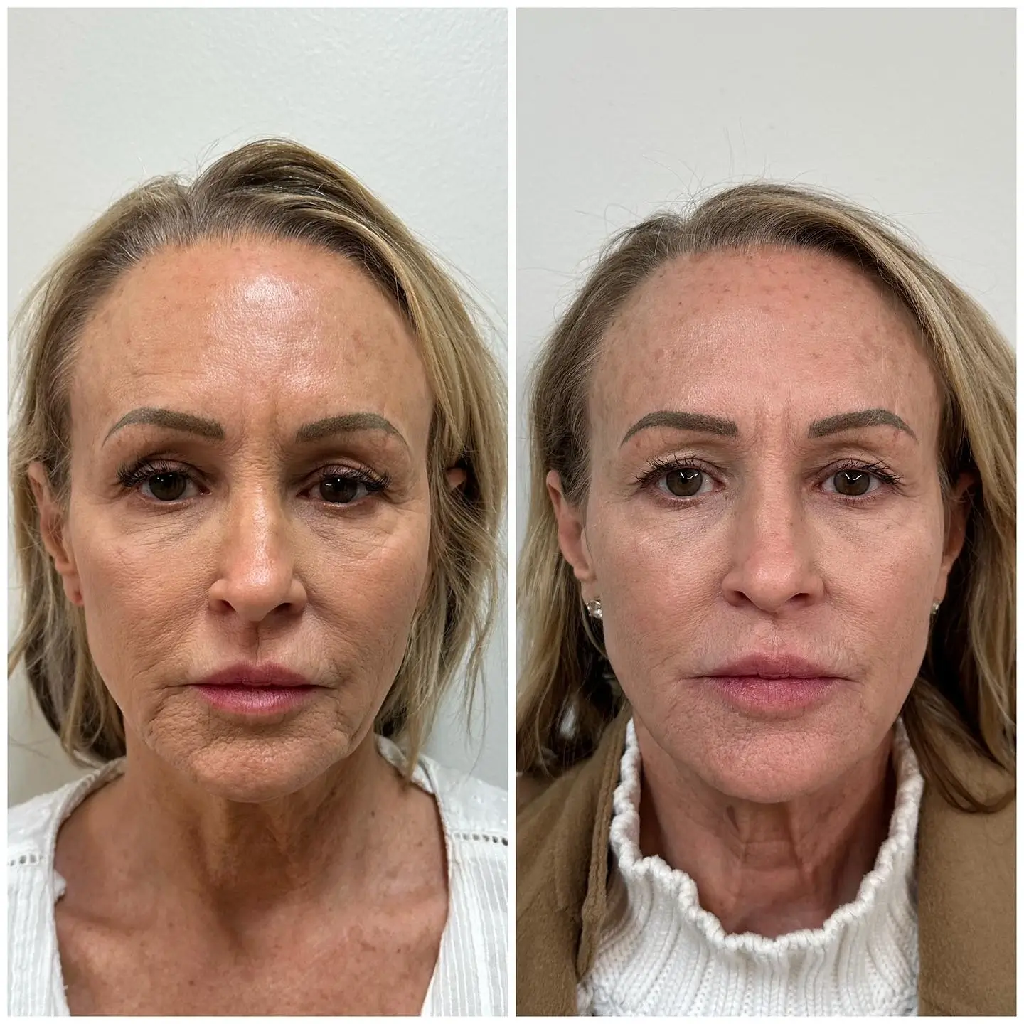 Skinvive Before and After