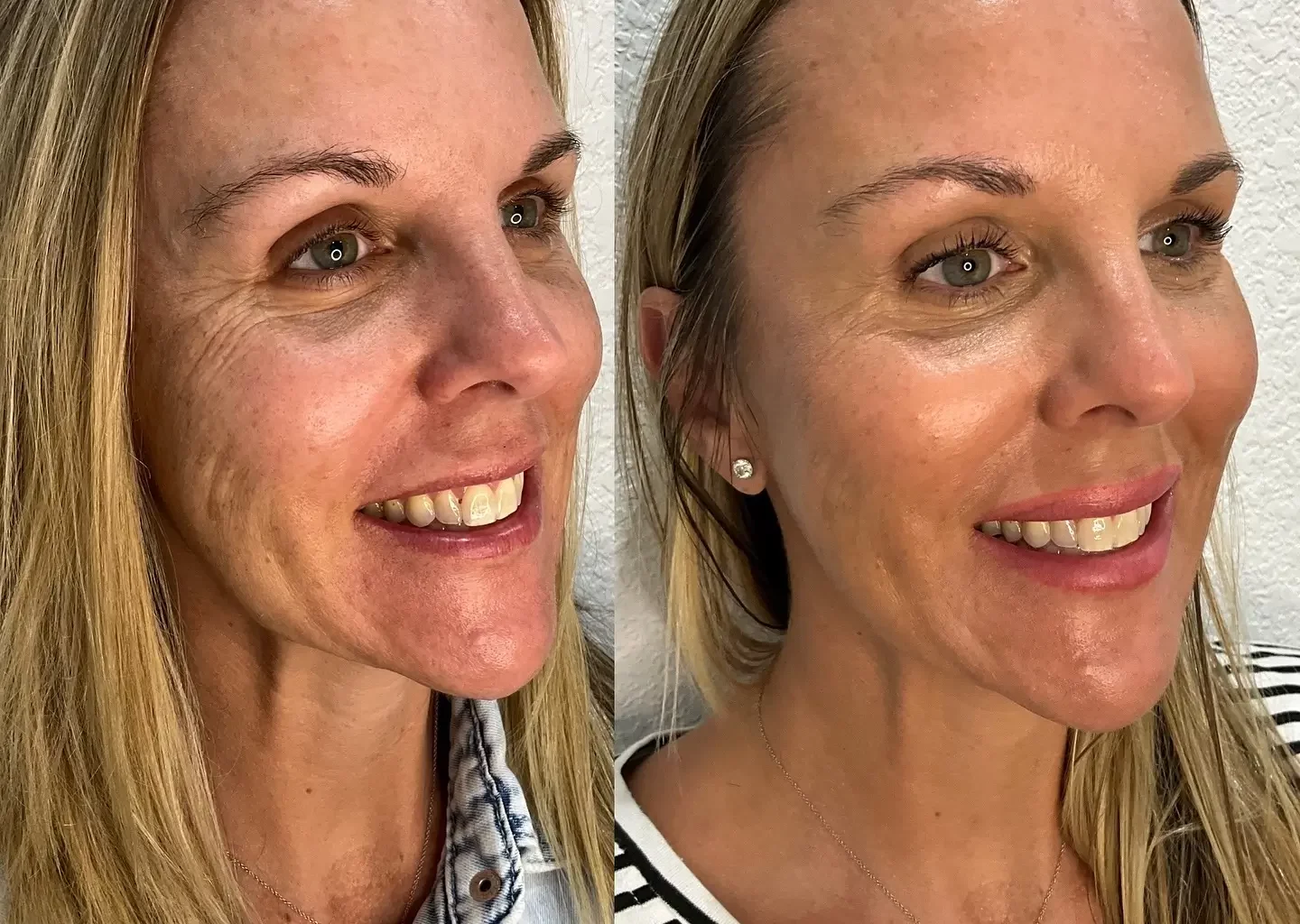 Skinvive Before and After