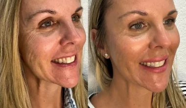 Skinvive Before and After