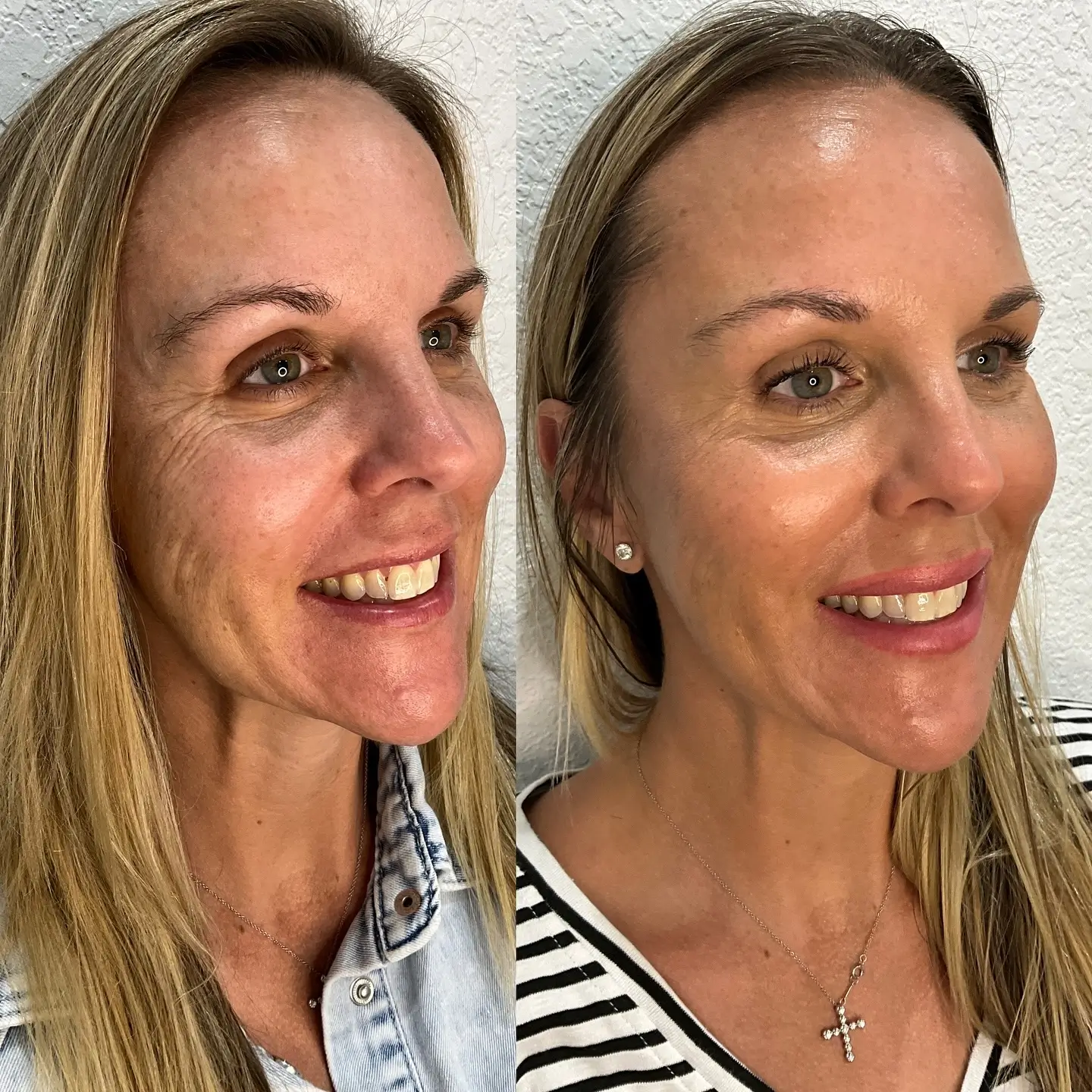 Skinvive Before and After - Before After Journey