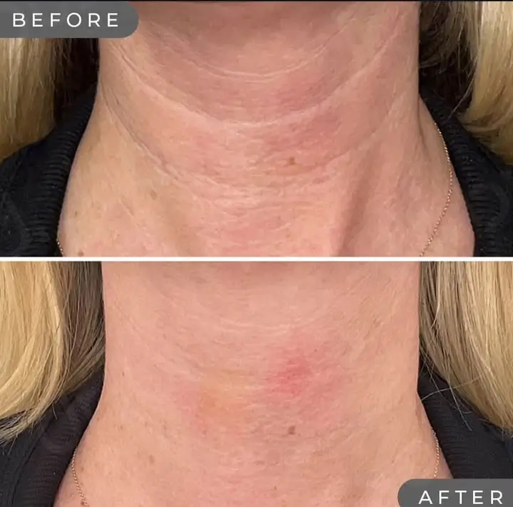 Skinvive Before and After