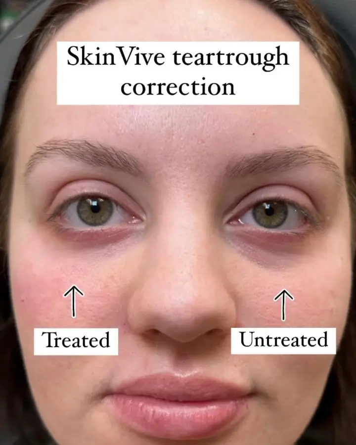 Skinvive Before and After