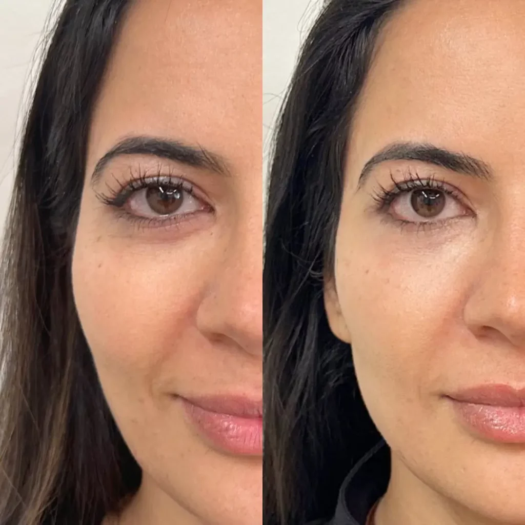 Skinvive Before and After