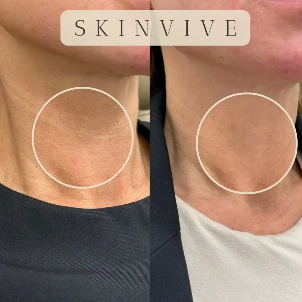 Skinvive Before and After