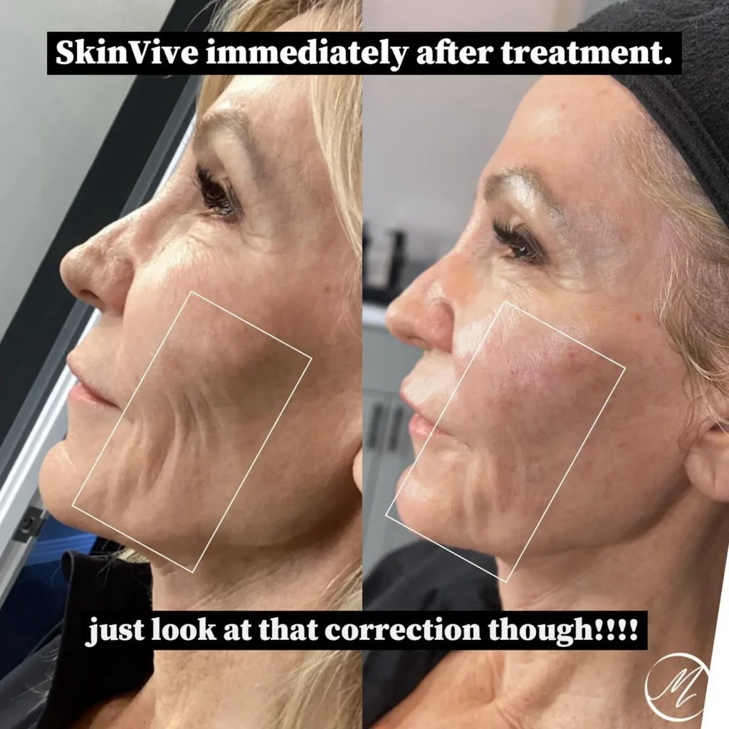 Skinvive Before and After