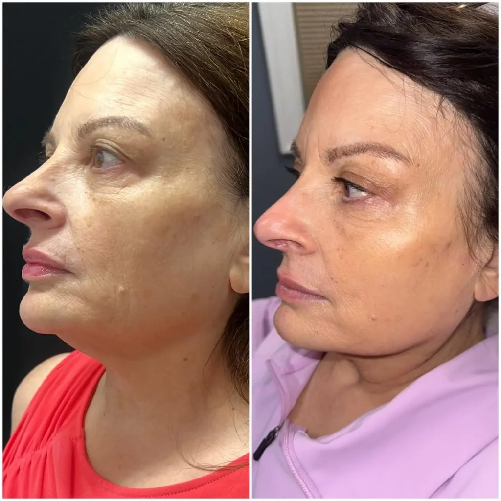 Skinvive Before and After