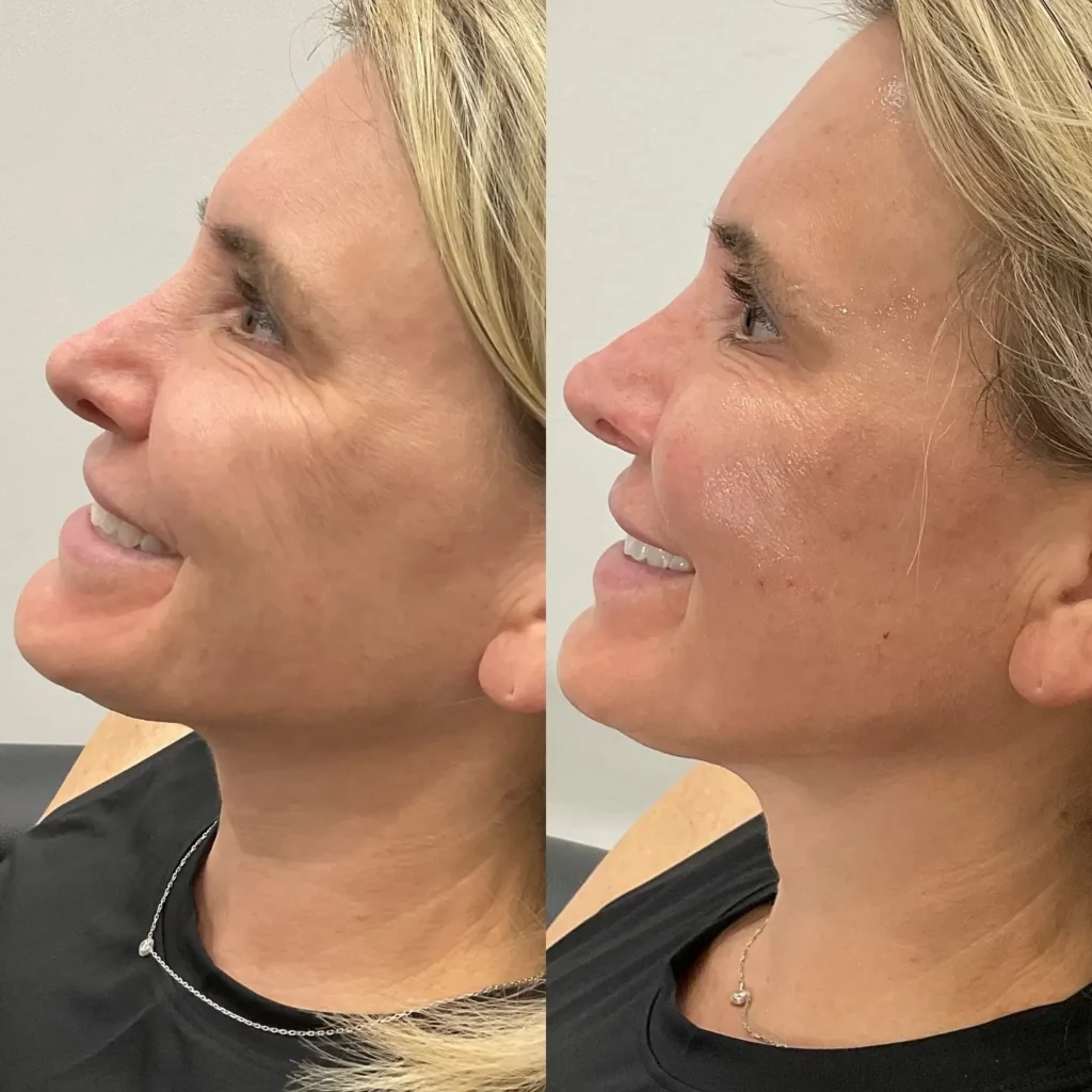 Skinvive Before and After