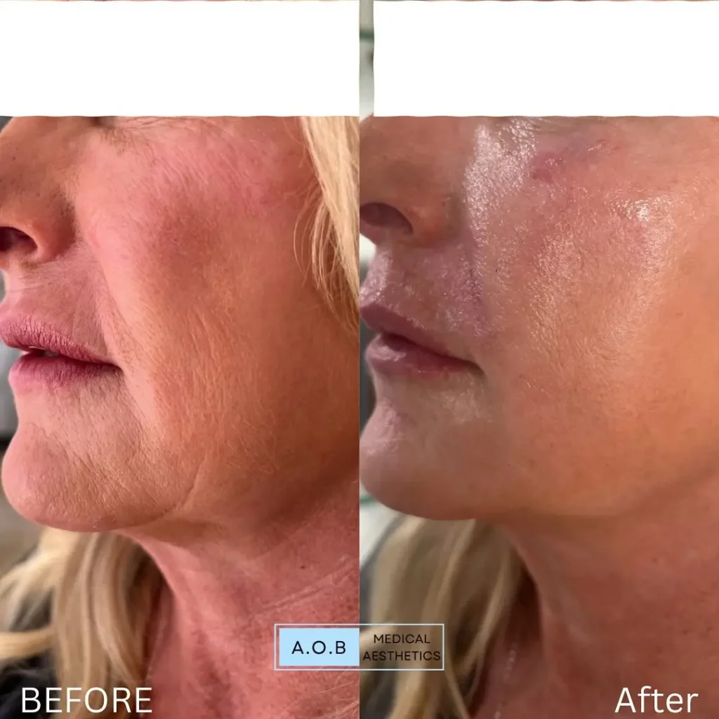 Skinvive Before and After