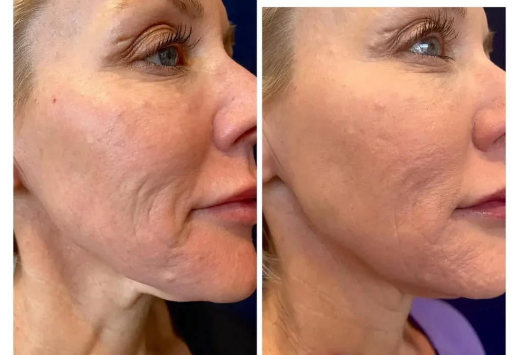 Skinvive Before and After